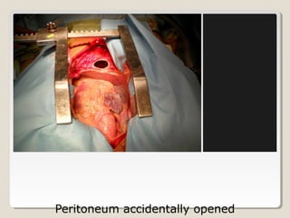 Peritoneum accidentally opened
 