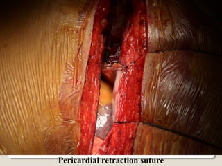Pericardial retraction suture
 