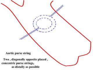 Aortic purse string
Two , diagonally opposite placed ,
concentric purse strings,
as distally as possible
 
