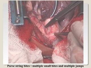 Purse string bites : multiple small bites and multiple jumps
 