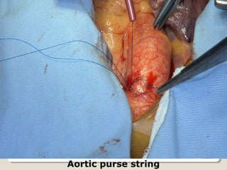 Aortic purse string
 