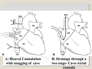 A: Bicaval Cannulation
with snugging of cave
B: Drainage through a
two stage- Cavo-Atrial
cannula
 