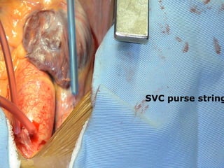 SVC purse string
 
