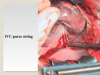 IVC purse string
 