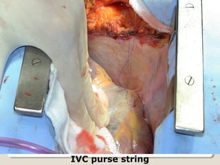 IVC purse string
 
