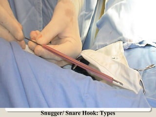 Snugger/ Snare Hook: Types
 