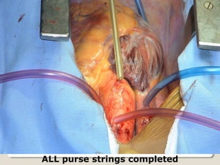 ALL purse strings completed
 