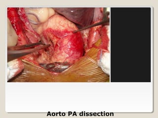Aorto PA dissection
 