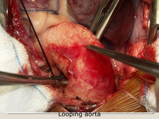 Looping aorta
 