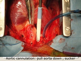 Aortic cannulation: pull aorta down , sucker
 