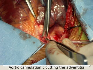 Aortic cannulation : cutting the adventitia
 