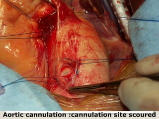 Aortic cannulation :cannulation site scoured
 