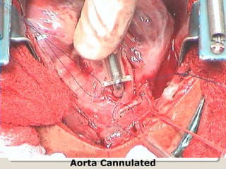 Aorta Cannulated
 