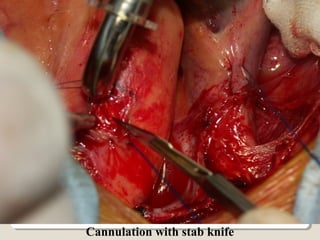 Cannulation with stab knife
 