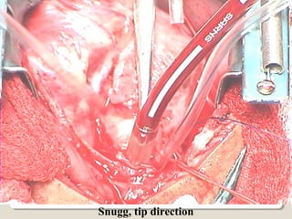 Snugg, tip direction
 