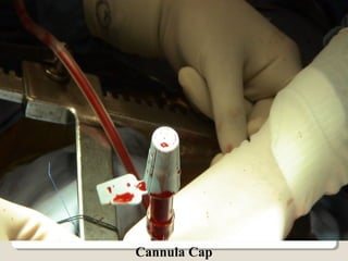 Cannula Cap
 