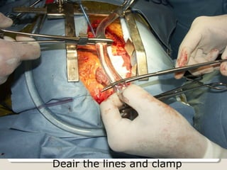 Deair the lines and clamp
 