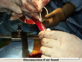 Disconnection if air found
 