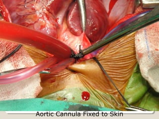 Aortic Cannula Fixed to Skin
 