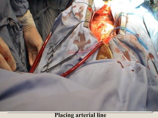 Placing arterial line
 