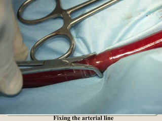 Fixing the arterial line
 