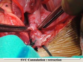 SVC Cannulation : retraction
 