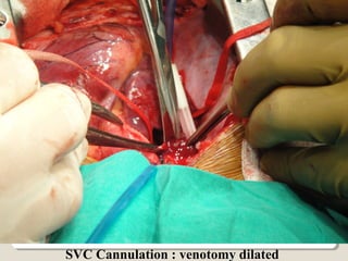 SVC Cannulation : venotomy dilated
 
