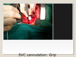 SVC cannulation: Grip
 