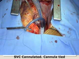 SVC Cannulated. Cannula tied
 