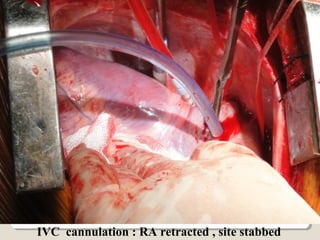 IVC cannulation : RA retracted , site stabbed
 