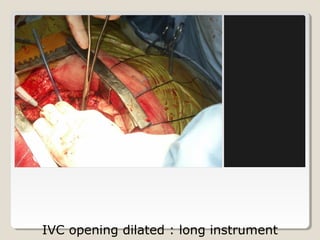 IVC opening dilated : long instrument
 