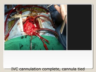 IVC cannulation complete, cannula tied
 