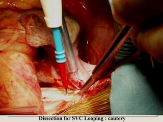 Dissection for SVC Looping : cautery
 