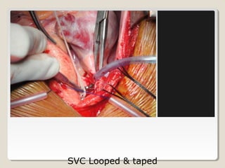 SVC Looped & taped
 