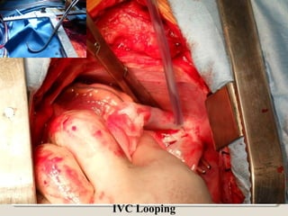 IVC Looping
 
