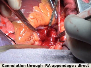 Cannulation through RA appendage : direct
 