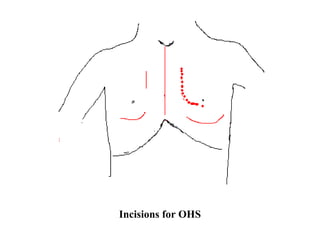 Incisions for OHS
 
