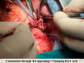 Cannulation through RA appendage : Clamping RAA tech
 