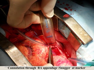 Cannulation through RA appendage :Snugger at marker
 