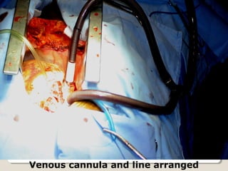 Venous cannula and line arranged
 