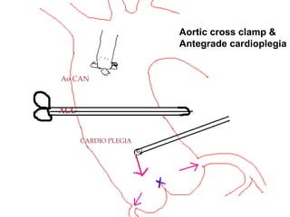 ACC
Ao CAN
CARDIO PLEGIA
Aortic cross clamp &
Antegrade cardioplegia
 