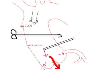 ACC
Ao CAN
CARDIO PLEGIA
Problem with
regurgitant aortic
valve
 