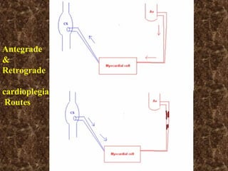 Antegrade
&
Retrograde
cardioplegia
Routes
 