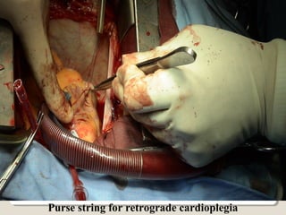 Purse string for retrograde cardioplegia
 