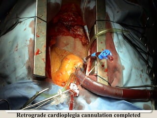 Retrograde cardioplegia cannulation completed
 