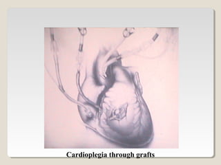 Cardioplegia through grafts
 