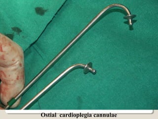 Ostial cardioplegia cannulae
 