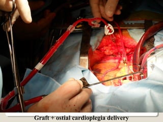Graft + ostial cardioplegia delivery
 