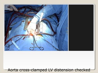 Aorta cross-clamped LV distension checked
 