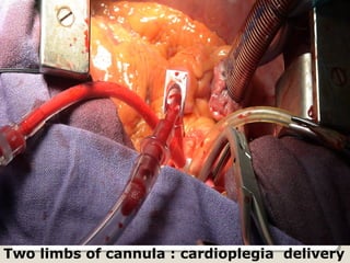 Two limbs of cannula : cardioplegia delivery
 
